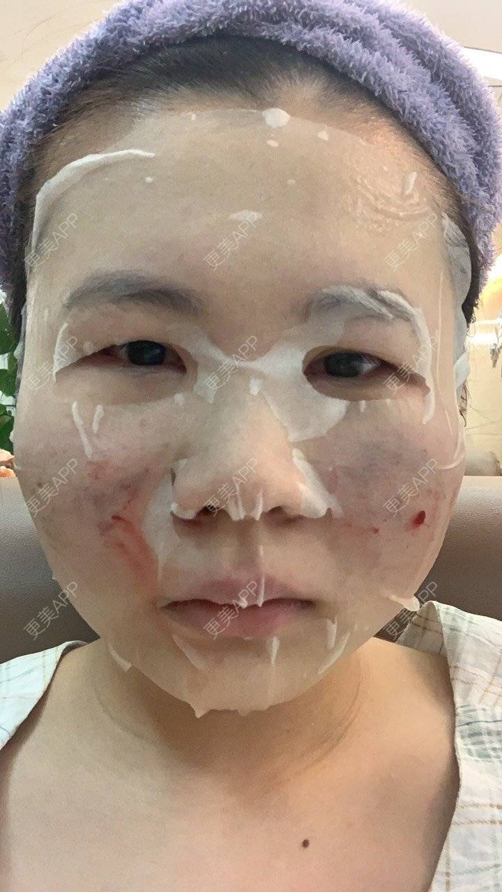 更美 - 灆妍的激光淡疤经验 | 激光淡疤 | 深圳