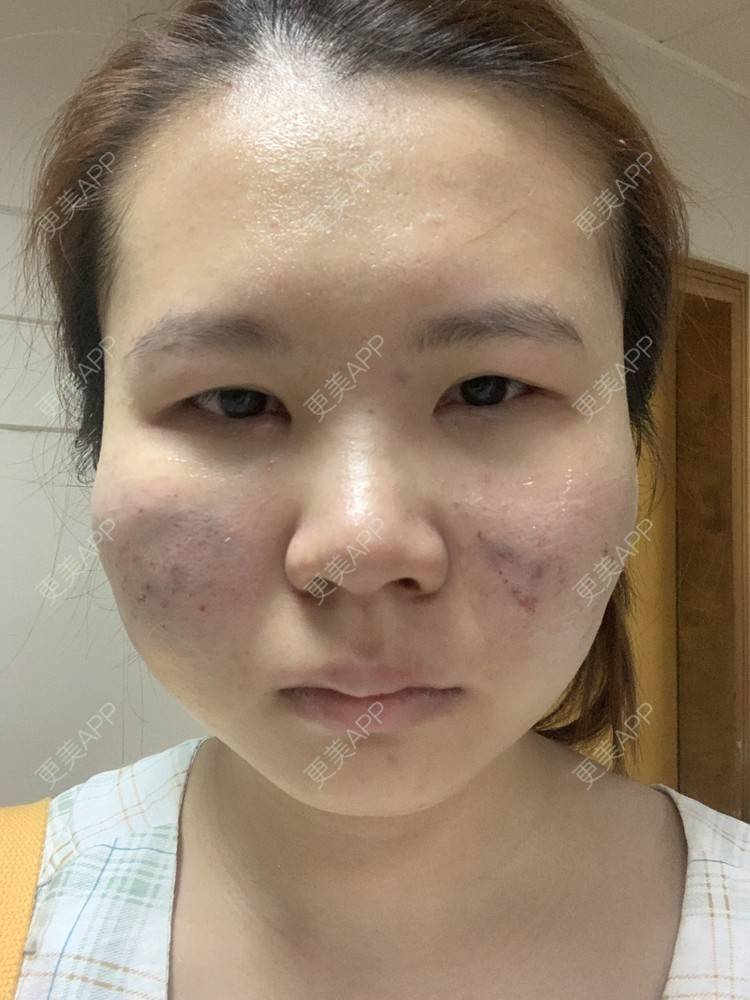 更美 - 灆妍的激光淡疤经验 | 激光淡疤 | 深圳