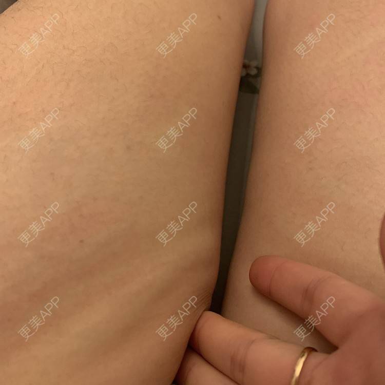 更美 - 更美用户JrJLC5yFo7的吸脂经验 | 吸脂 | 南京