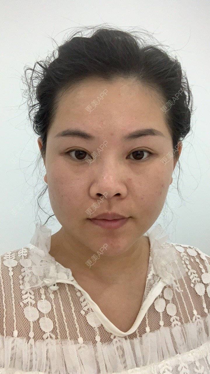 更美 - 韩韩巨蟹座的玻尿酸法令纹经验 | 玻尿酸面部细纹 | 哈尔滨 | 玻尿酸