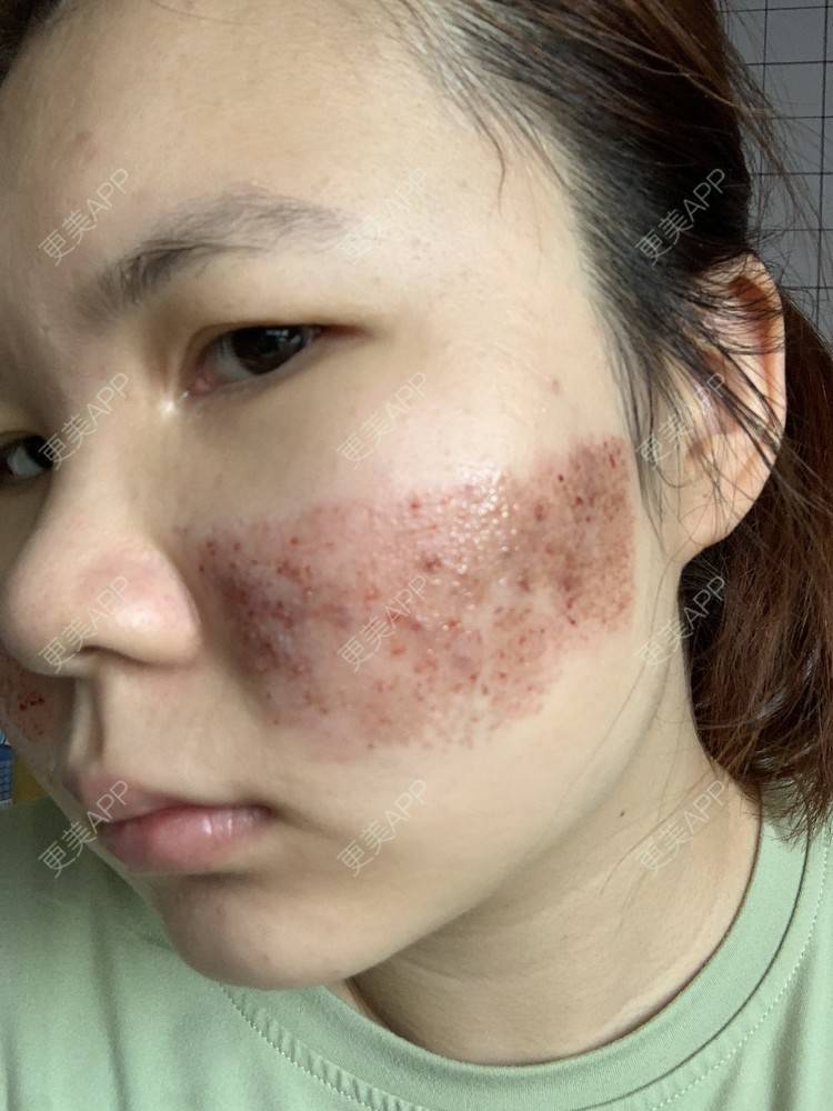 更美 - 灆妍的激光淡疤经验 | 深圳 | 激光淡疤