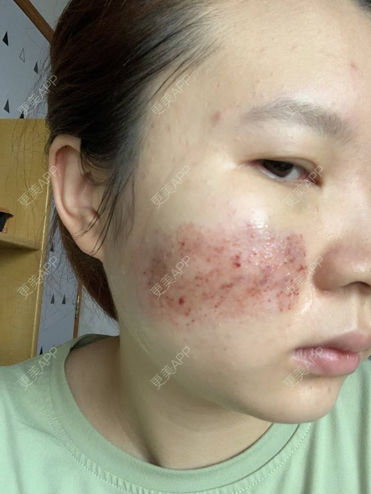 更美 - 灆妍的激光淡疤经验 | 深圳 | 激光淡疤