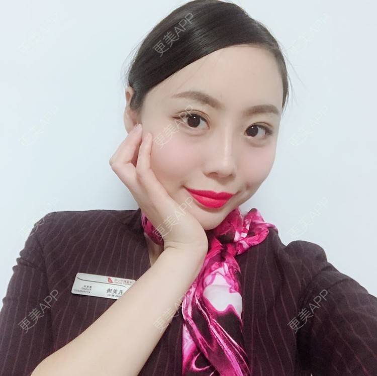 更美 - 更美用户QhDs9RVr2A的玻尿酸面部细纹经验 | 上海 | 玻尿酸面部细纹