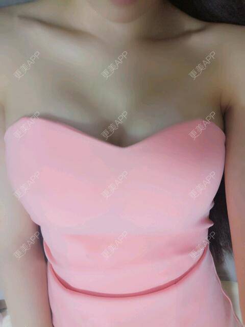 更美 - 更美用户2o60cQKUEs的假体隆胸经验 | 假体隆胸 | 乳头再造 | 美胸套餐 | 重庆