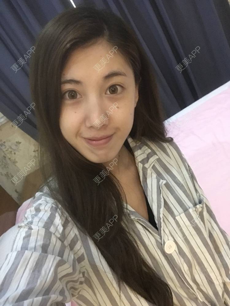 更美 - 滴滴拉的膨体隆鼻经验 | 膨体隆鼻 | 长春
