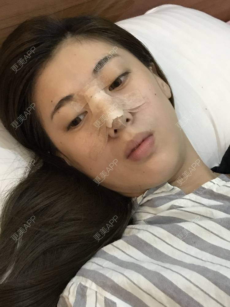 更美 - 滴滴拉的膨体隆鼻经验 | 膨体隆鼻 | 长春