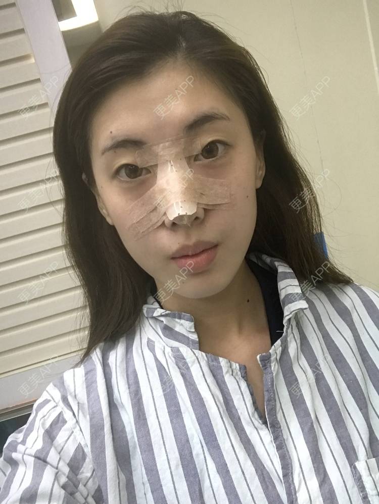 更美 - 滴滴拉的膨体隆鼻经验 | 膨体隆鼻 | 长春