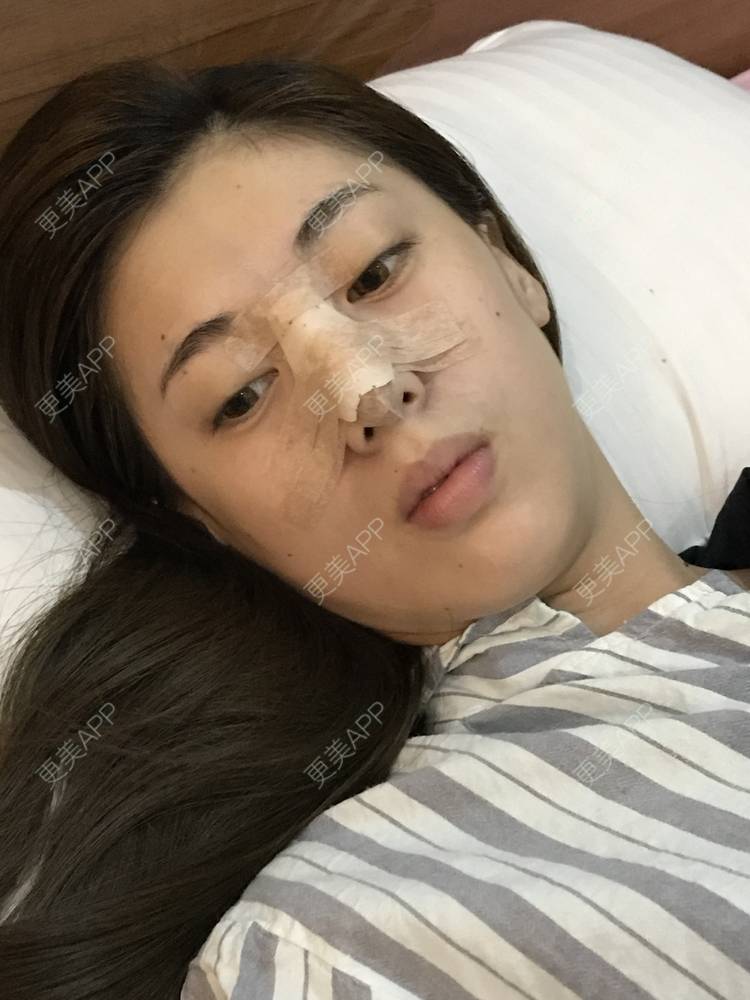 更美 - 滴滴拉的膨体隆鼻经验 | 膨体隆鼻 | 长春
