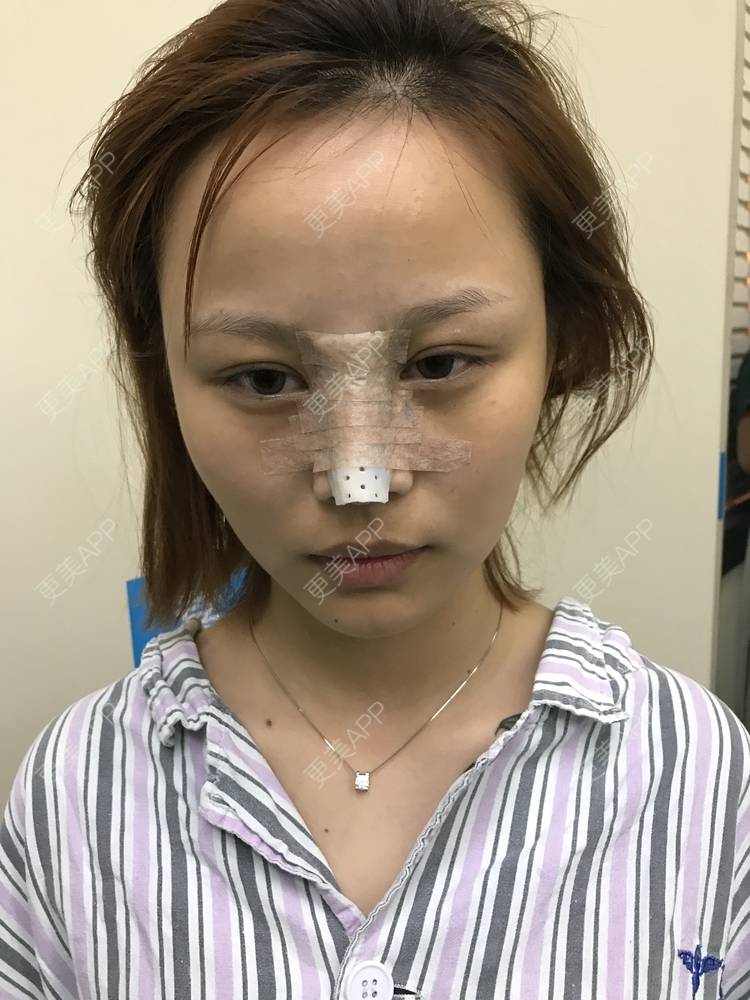 更美 - 卡卡。。的隆鼻经验 | 隆鼻 | 长春