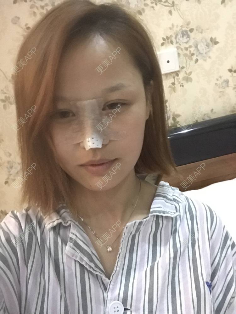 更美 - 卡卡。。的隆鼻经验 | 隆鼻 | 长春