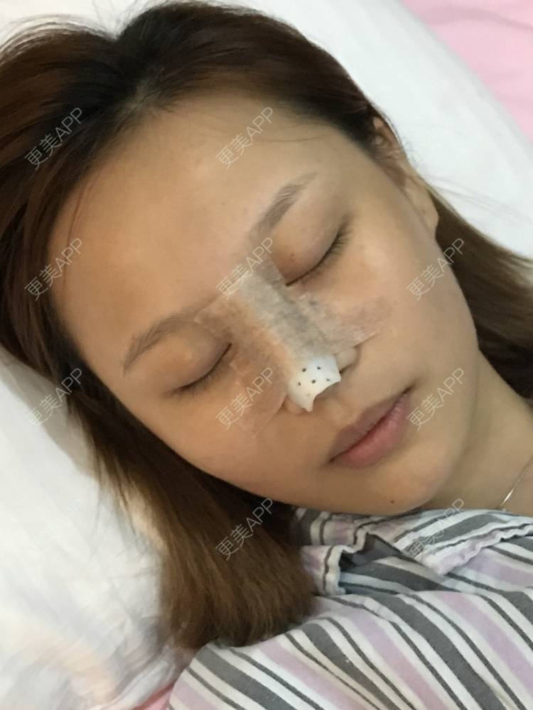 更美 - 卡卡。。的隆鼻经验 | 隆鼻 | 长春