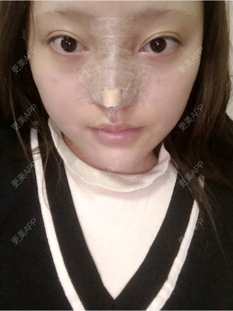 更美 - 更美用户ZSYAfLAIcp的硅胶隆鼻经验 | 耳软骨隆鼻 | 硅胶隆鼻 | 长春
