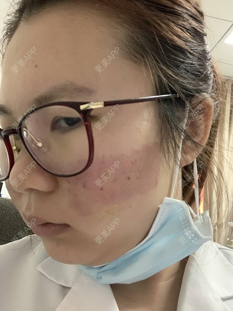 更美 - 灆妍的激光淡疤经验 | 深圳 | 激光淡疤