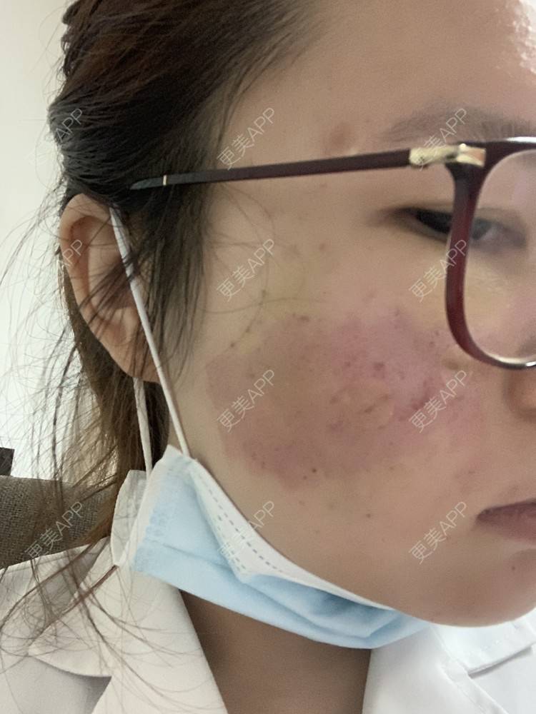 更美 - 灆妍的激光淡疤经验 | 深圳 | 激光淡疤