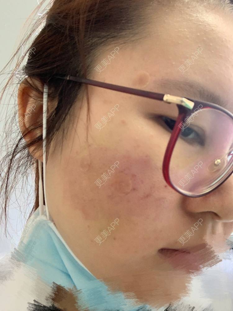 更美 - 灆妍的激光淡疤经验 | 深圳 | 激光淡疤