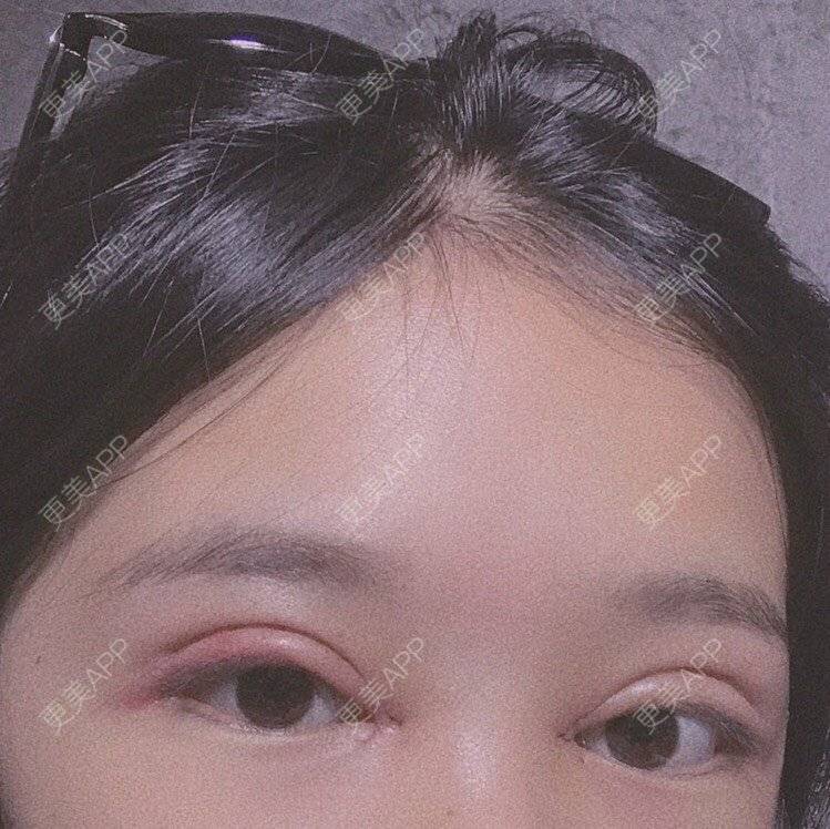 更美 - 更美用户pw2FXbUb8o的全切双眼皮经验 | 全切双眼皮 | 开内眼角 | 贵阳 | 眼部多项