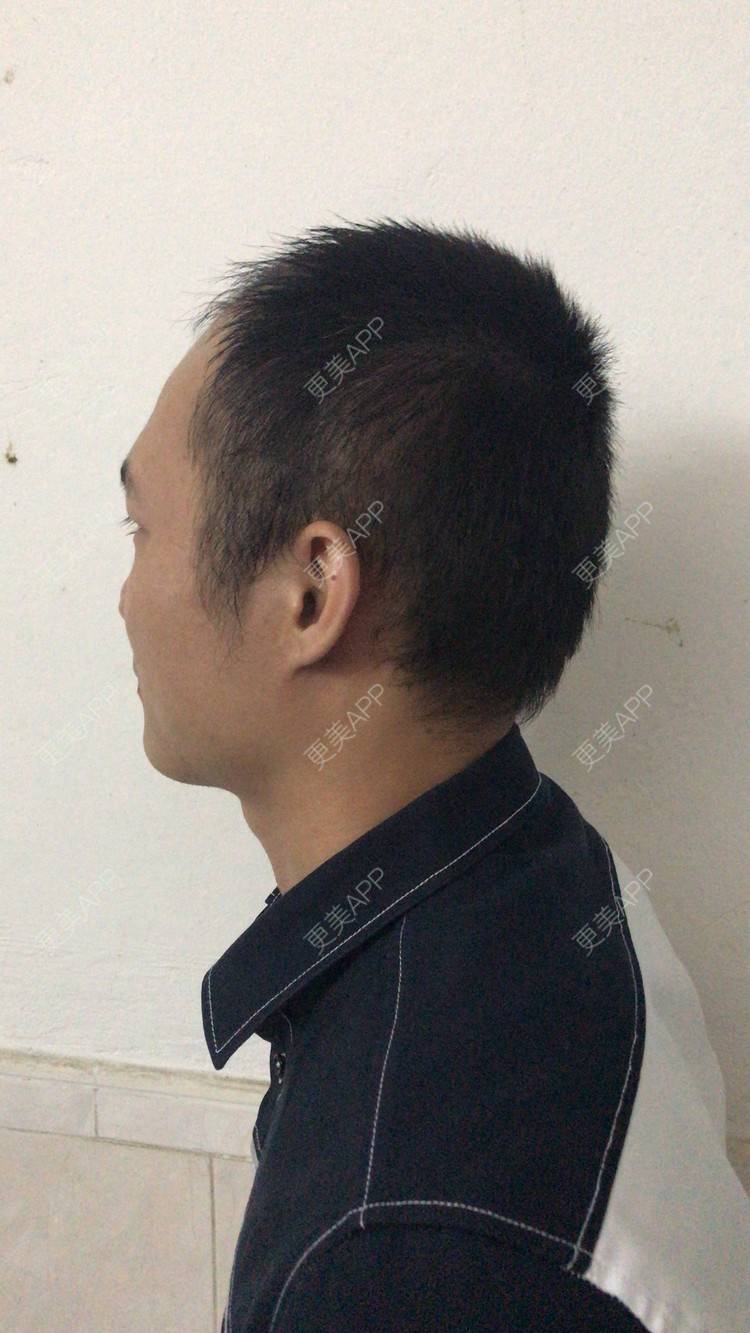更美 - 更美用户y5O1wsEQkc的鬓角植发经验 | 广州 | 鬓角植发