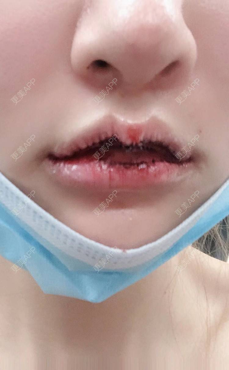 更美用户lwwu9dba4f的m唇成形术日记