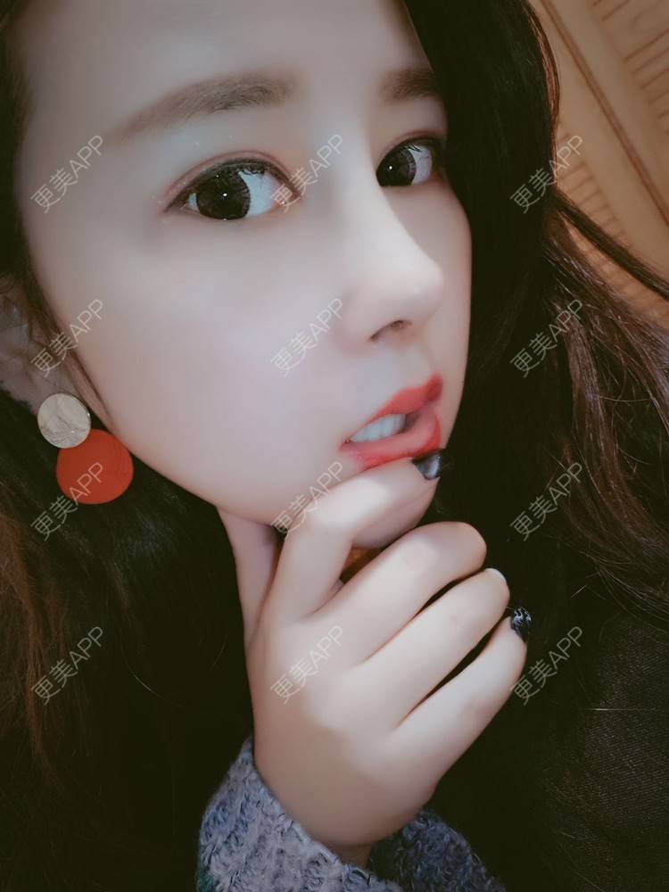 耳软骨隆鼻效果图_蹙眉衫耳软骨隆鼻效果图_术后32天__更美