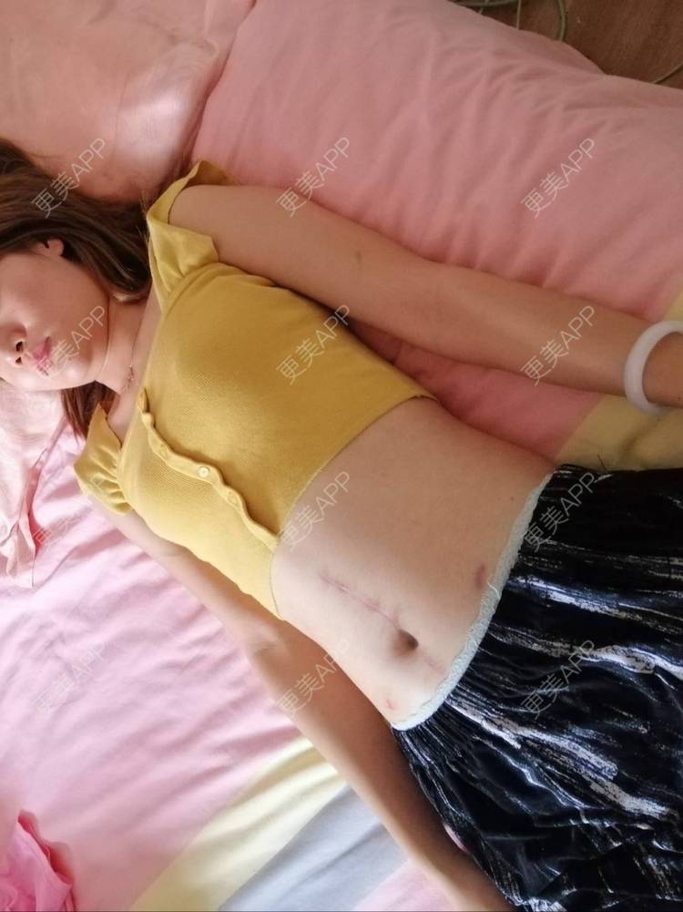 更美 - ┈━═☆冒的激光淡疤经验 | 注射淡疤 | 激光淡疤 | 成都