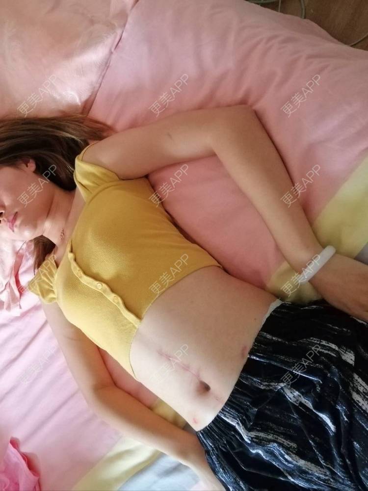 更美 - ┈━═☆冒的激光淡疤经验 | 注射淡疤 | 激光淡疤 | 成都