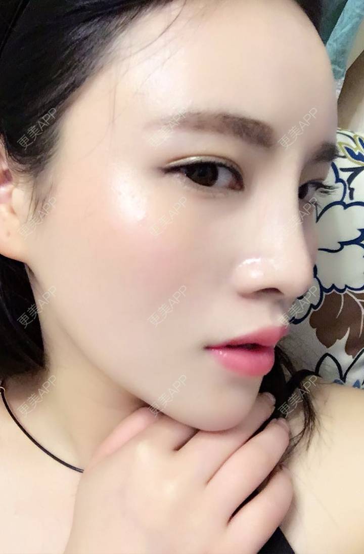 彼得潘的假童话搜的膨体隆鼻日记