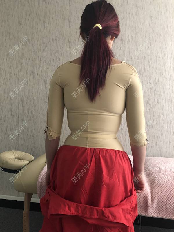 更美用户vfih8liwoy的肩部吸脂日记