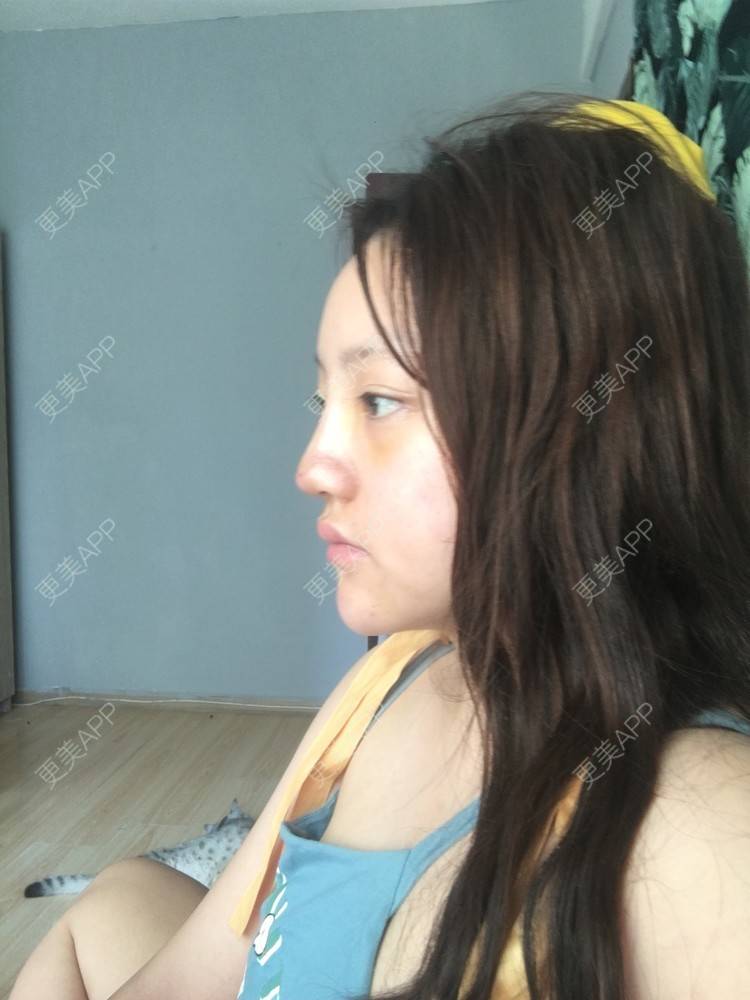 更美 - 更美用户ZSYAfLAIcp的硅胶隆鼻经验 | 耳软骨隆鼻 | 硅胶隆鼻 | 长春