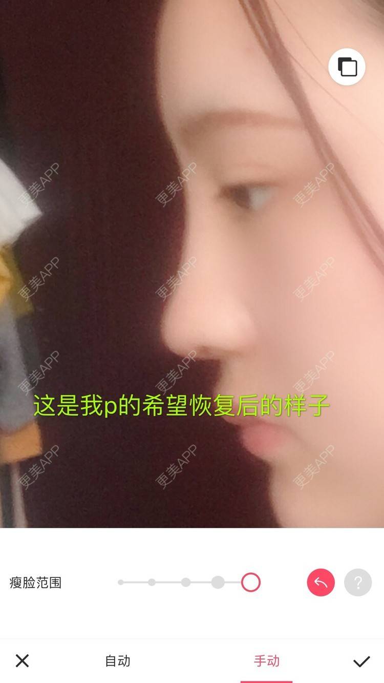 更美 - 更美用户ZSYAfLAIcp的硅胶隆鼻经验 | 耳软骨隆鼻 | 硅胶隆鼻 | 长春
