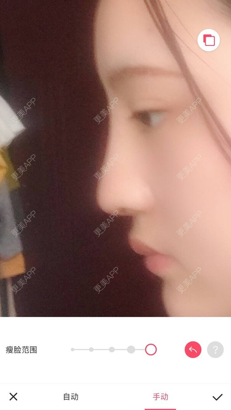 更美 - 更美用户ZSYAfLAIcp的硅胶隆鼻经验 | 耳软骨隆鼻 | 硅胶隆鼻 | 长春