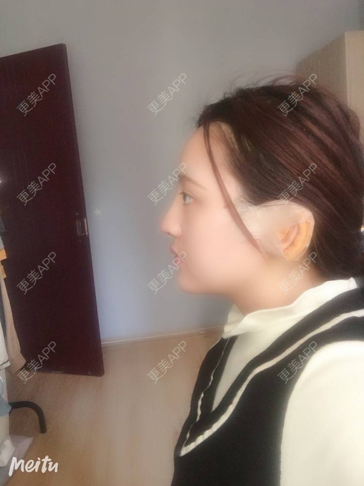 更美 - 更美用户ZSYAfLAIcp的硅胶隆鼻经验 | 耳软骨隆鼻 | 硅胶隆鼻 | 长春
