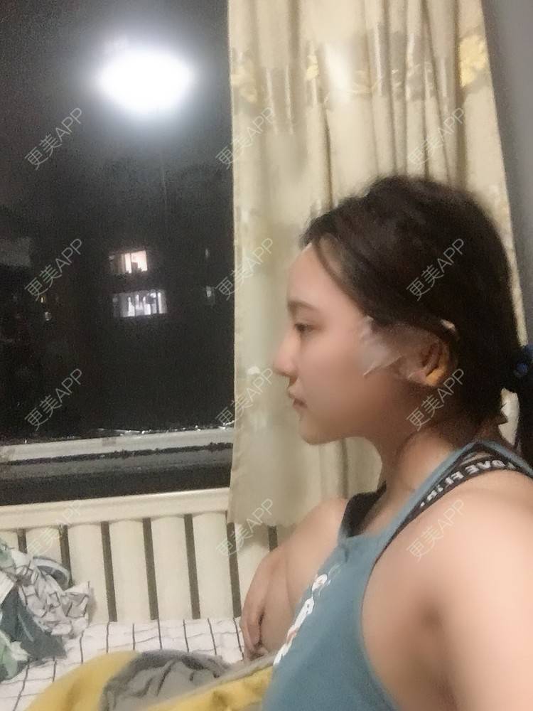 更美 - 更美用户ZSYAfLAIcp的硅胶隆鼻经验 | 耳软骨隆鼻 | 硅胶隆鼻 | 长春