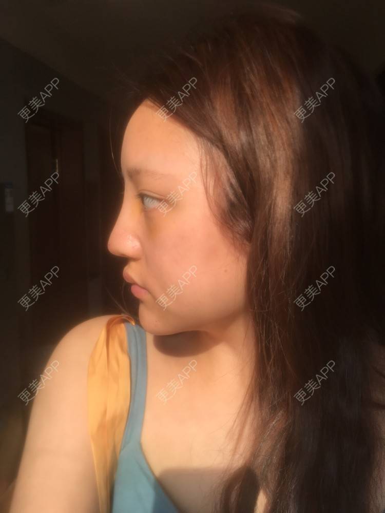 更美 - 更美用户ZSYAfLAIcp的硅胶隆鼻经验 | 耳软骨隆鼻 | 硅胶隆鼻 | 长春