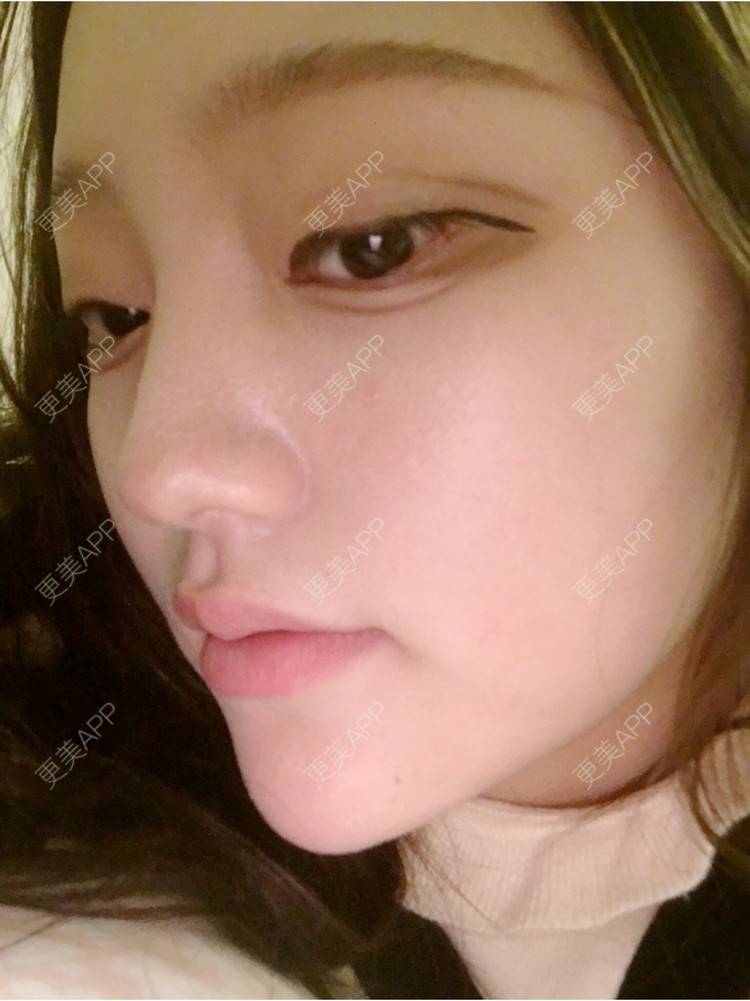 更美 - 更美用户ZSYAfLAIcp的硅胶隆鼻经验 | 硅胶隆鼻 | 长春