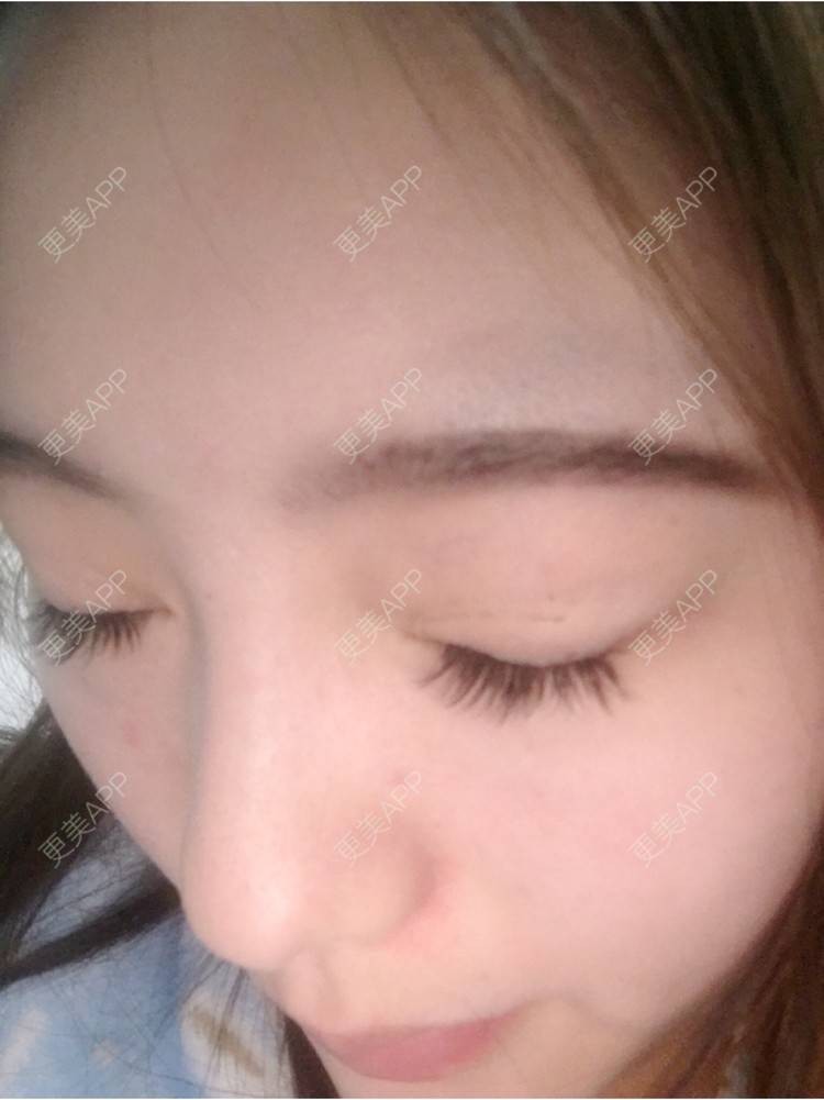 更美 - 更美用户ZSYAfLAIcp的硅胶隆鼻经验 | 硅胶隆鼻 | 长春
