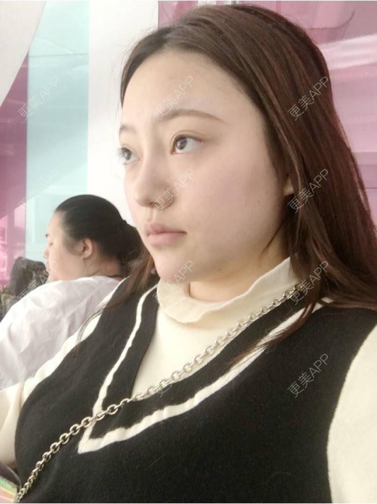 更美 - 更美用户ZSYAfLAIcp的硅胶隆鼻经验 | 硅胶隆鼻 | 长春