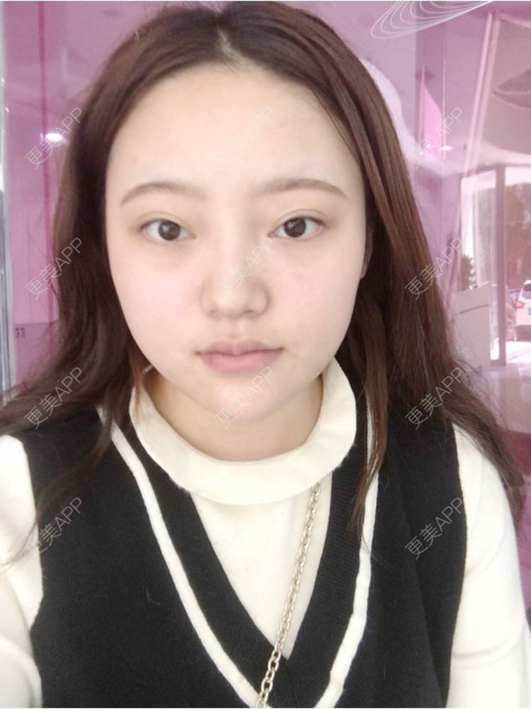 更美 - 更美用户ZSYAfLAIcp的硅胶隆鼻经验 | 硅胶隆鼻 | 长春