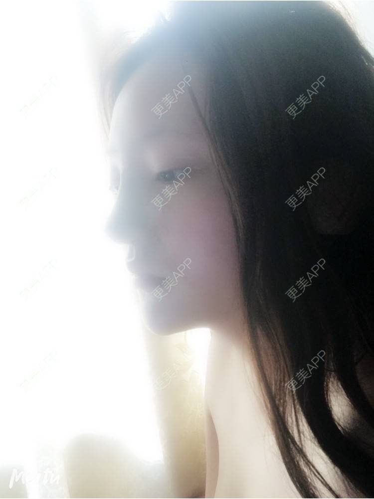 更美 - 更美用户ZSYAfLAIcp的硅胶隆鼻经验 | 耳软骨隆鼻 | 硅胶隆鼻 | 长春