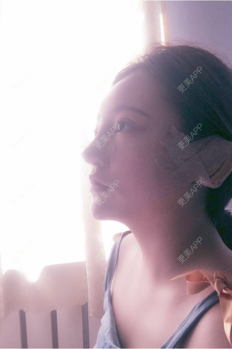 更美 - 更美用户ZSYAfLAIcp的硅胶隆鼻经验 | 耳软骨隆鼻 | 硅胶隆鼻 | 长春
