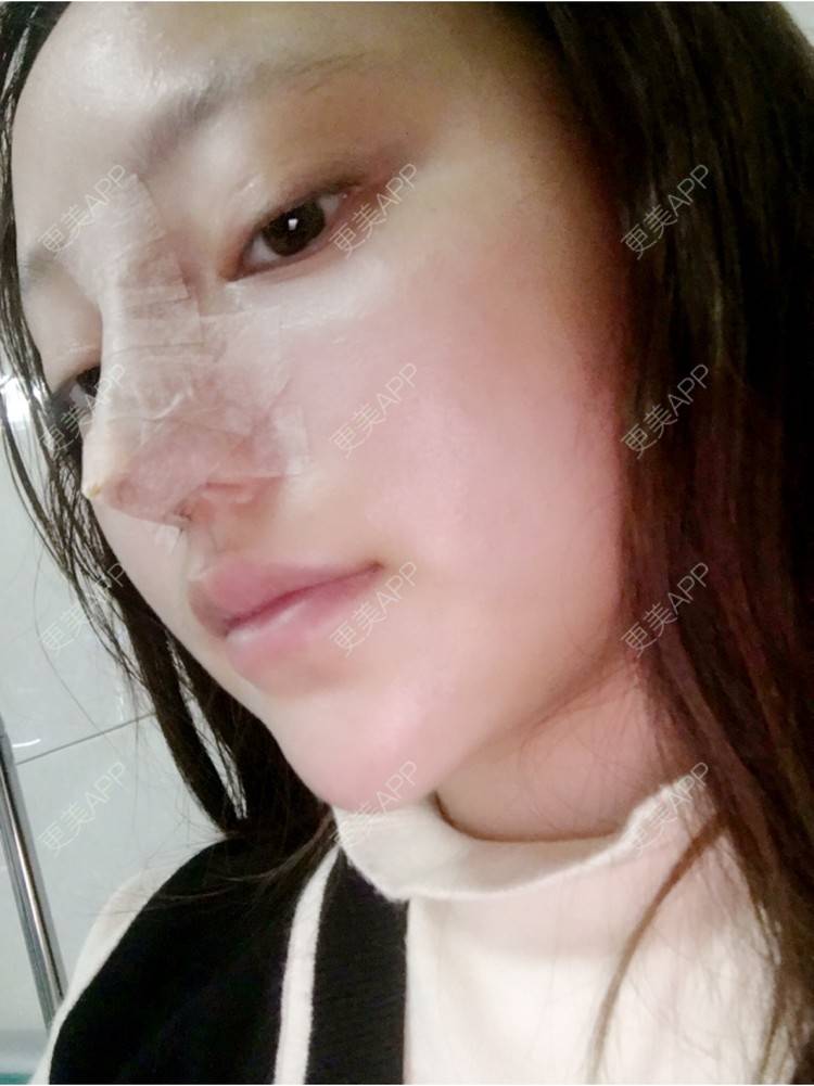 更美 - 更美用户ZSYAfLAIcp的硅胶隆鼻经验 | 耳软骨隆鼻 | 硅胶隆鼻 | 长春