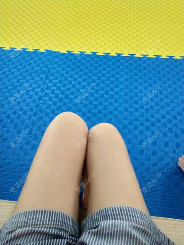 更美用户lqn2r1p6kk的吸脂瘦大腿日记