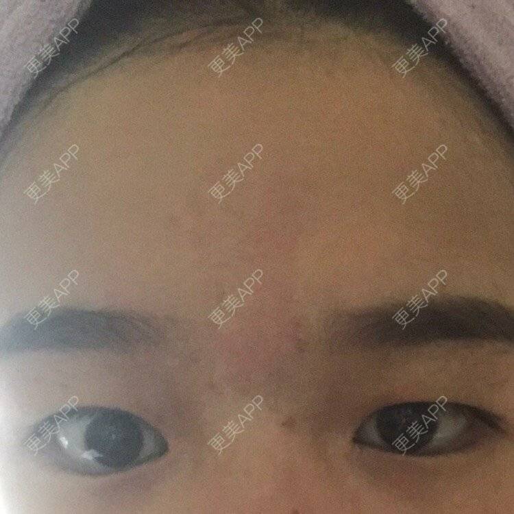 更美 - 更美用户pw2FXbUb8o的全切双眼皮经验 | 全切双眼皮 | 开内眼角 | 贵阳 | 眼部多项