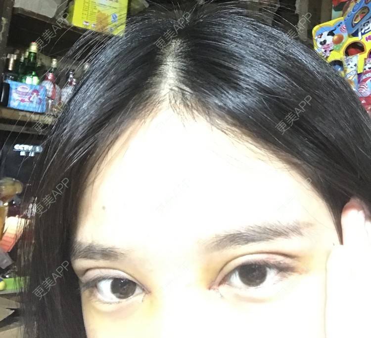 更美 - 更美用户pw2FXbUb8o的全切双眼皮经验 | 全切双眼皮 | 开内眼角 | 贵阳 | 眼部多项