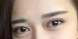 更美 - 更美用户XGxTKxXGFX的真皮丰卧蚕经验 | 真皮丰卧蚕 | 武汉