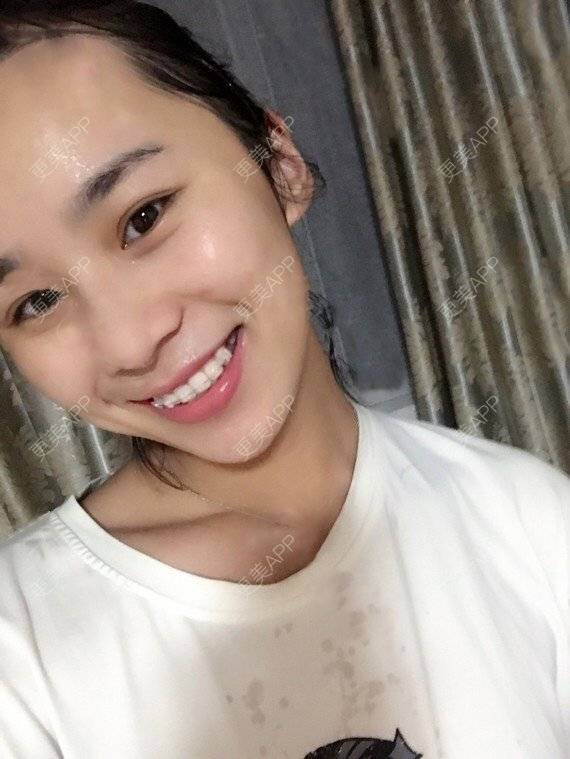 更美 - 宝儿姐😄的全瓷牙经验 | 全瓷牙 | 合金烤瓷牙 | 二氧化锆烤瓷牙
