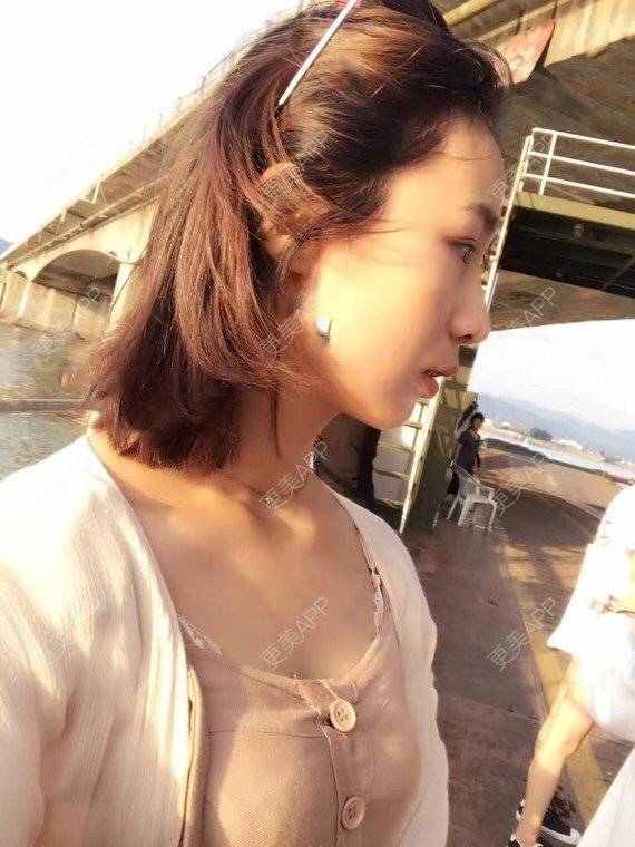 更美 - 宝儿姐😄的全瓷牙经验 | 全瓷牙 | 合金烤瓷牙 | 二氧化锆烤瓷牙
