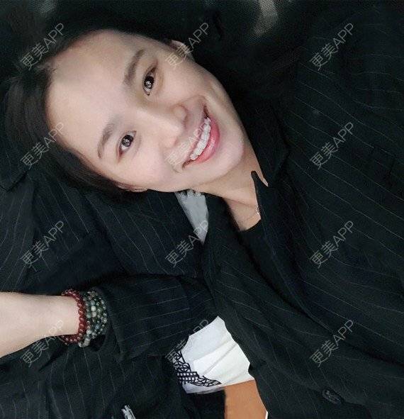 更美 - 宝儿姐😄的全瓷牙经验 | 全瓷牙 | 合金烤瓷牙 | 二氧化锆烤瓷牙