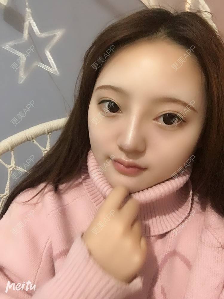 更美 - 更美用户ZSYAfLAIcp的硅胶隆鼻经验 | 硅胶隆鼻 | 长春 | 耳软骨隆鼻