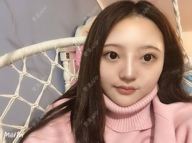 更美 - 更美用户ZSYAfLAIcp的硅胶隆鼻经验 | 硅胶隆鼻 | 长春 | 耳软骨隆鼻