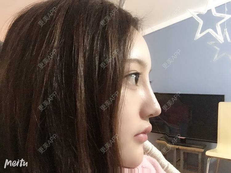 更美 - 更美用户ZSYAfLAIcp的硅胶隆鼻经验 | 硅胶隆鼻 | 长春 | 耳软骨隆鼻